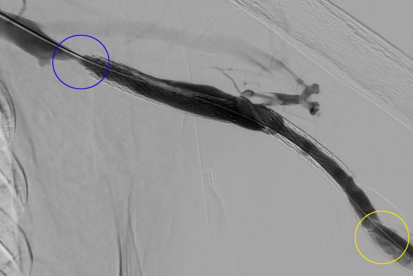 Röntgenbilder vor der Implantation des dreifach beschichteten Stents.