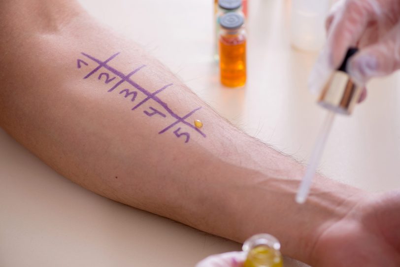 Menschen in Herne sollten Allergiesymptome ärztlich abklären lassen. Unbehandelt können sich Allergien verschlimmern und eventuell ein sogenannter Etagenwechsel entstehen und aus dem allergischen Schnupfen entwickelt sich eine Asthmaerkrankung.